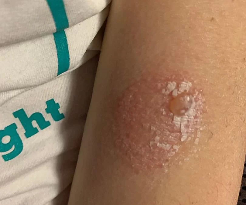 Allergia al Nichel e la coltivazione idroponica: in Penisola Sorrentina si possono acquistare i pomodori senza nichel